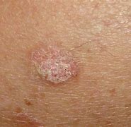 Image result for Severe Actinic Keratosis