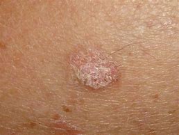 Image result for Benign Skin Lesions Keratosis