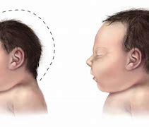 Image result for Microcephaly Brazil