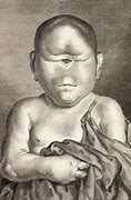 Image result for Human Forms of Cyclopia