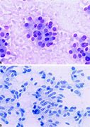 Image result for Carcinoid Cytology