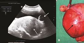 Image result for 7Cm Fibroid