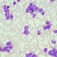 Image result for CML Leukemia