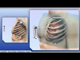 Image result for Pneumothorax Thoracic Vent
