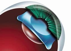 Image result for Phakic Intraocular Lens