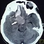 Image result for Carotid Artery Rupture