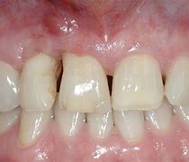 Image result for Bone Loss Dentures