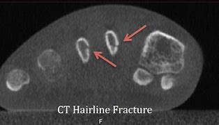Image result for Hairline Fractures iPhone