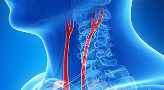 Image result for Carotid and Vertebral Arteries