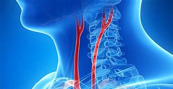 Image result for Carotid Artery Bypass