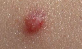 Image result for HPV Warts in Men