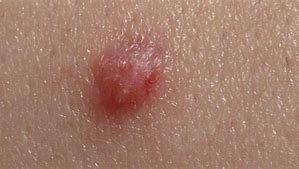 Image result for Warts Gentual