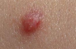 Image result for Warts HPV Virus Male