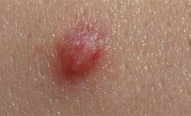 Image result for Genital Wart Lesion Type