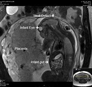 Image result for Anencephaly in MRI