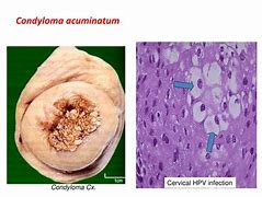 Image result for Condyloma Types