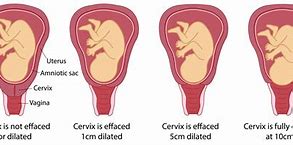 Image result for Dilatation of Cervix