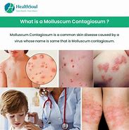 Image result for Molluscum Contagiosum Prevention