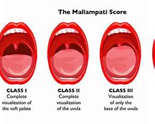 Image result for Mallampati Class