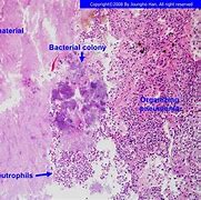 Image result for acginomicosis