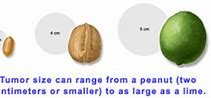 Image result for How Big Is 26 Cm Tumor
