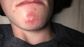 Image result for Large Red Spots On Skin