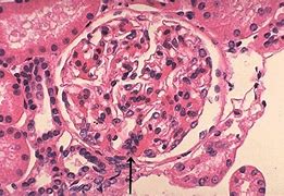 Image result for IgA Nephropathy Berger's Disease