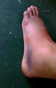 Image result for Swollen Feet Turning Black