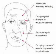 Image result for Bell's Palsy Forehead Sparing