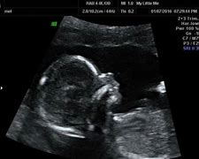 Image result for Fetal Skull Ultrasound