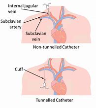 Image result for Central Venous Catheter Dialysis