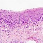 Image result for Squamous Dysplasia