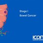 Image result for Bowel Cancer Stages