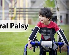 Image result for Cerebral Palsy Microcephaly