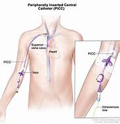 Image result for PICC Line Ports