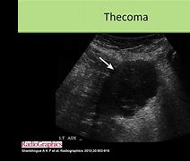 Image result for Thecoma Fibroma Ultrasound