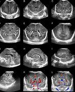 Image result for Normal Cranial Ultrasound