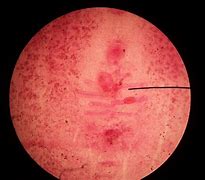 Image result for diphyllobothriasis