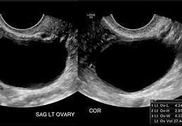 Image result for Adnexal Cyst with Polyp Ultrasound