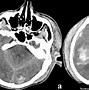 Image result for Iph CT