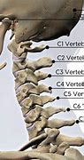 Image result for C5 C6 Cervical Spine Anatomy Diagram