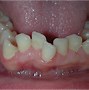 Image result for Proclined Incisors