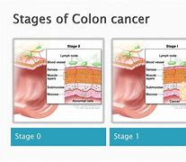 Image result for Anemia in Colorectal Cancer
