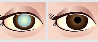 Image result for Cataract Vision Before and After