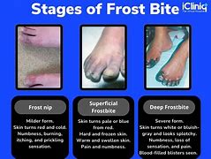 Image result for Sun Burn 2nd Degree Popped Blisters