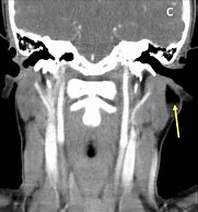 Image result for Dermoid Cyst MRI