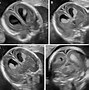 Image result for Fetal Head Mass Ultrasound