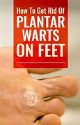 Image result for Seed Warts Treatment