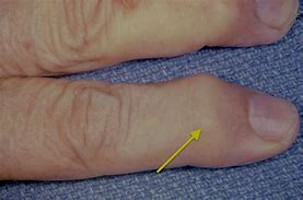 Image result for Nodules On Finger Joints Knuckles