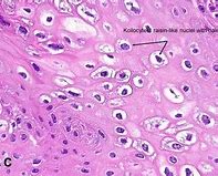 Image result for Pointed Condyloma
